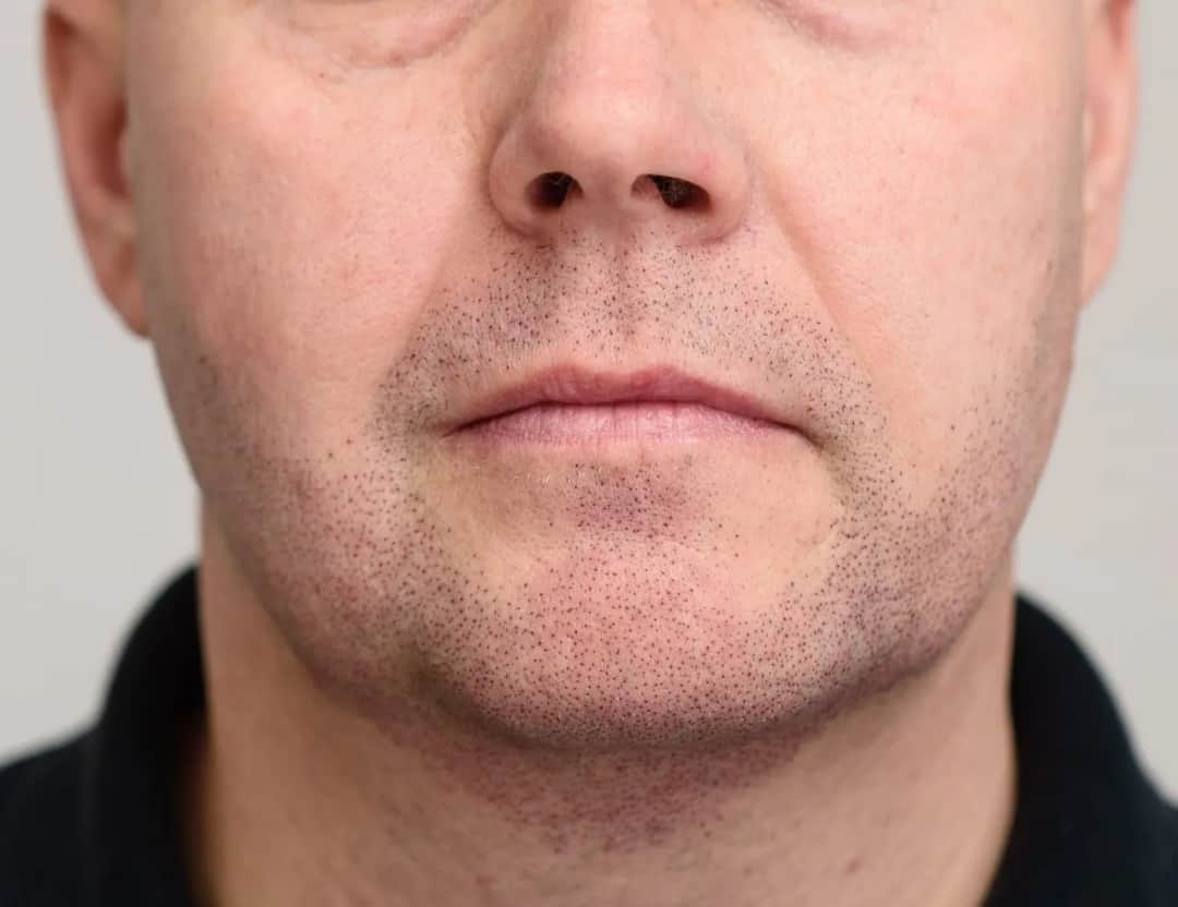 Skuteczne sposoby na pozbycie się zarostu na twarzy bez bólu i podrażnień