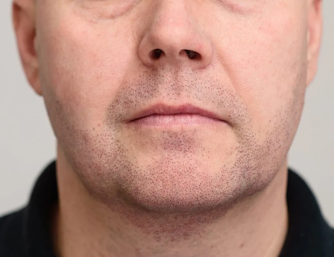 Skuteczne sposoby na pozbycie się zarostu na twarzy bez bólu i podrażnień