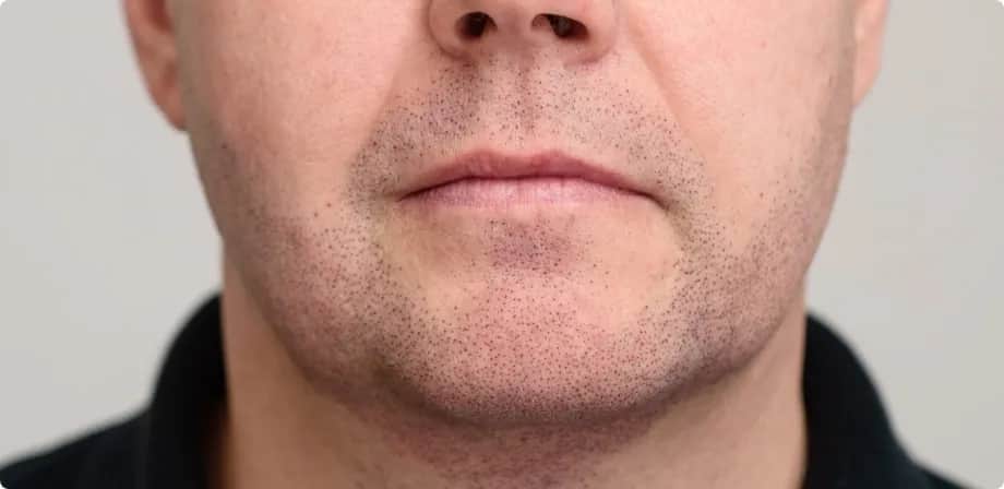 Dlaczego nie mam zarostu: poznaj 7 najczęstszych przyczyn braku brody